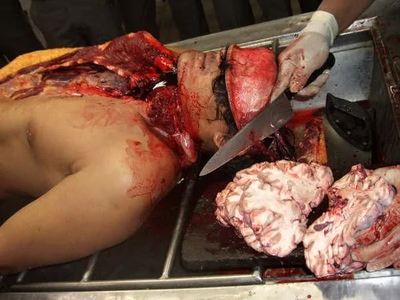 A collection of autopsies of various men