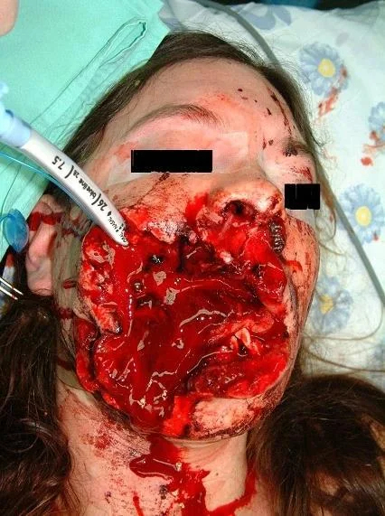 Severe facial trauma of varying degrees