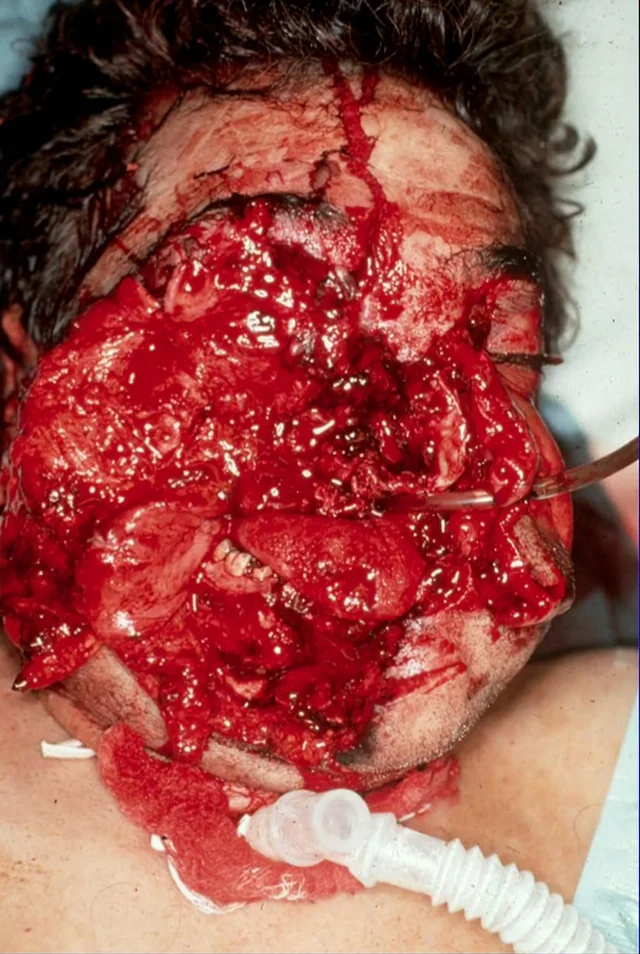 Severe facial trauma of varying degrees