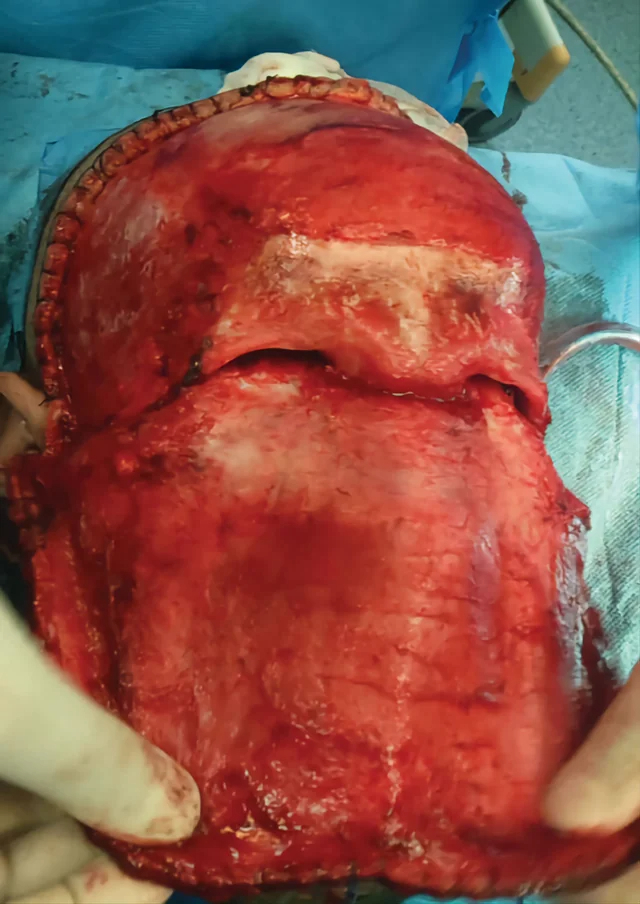 Severe facial trauma of varying degrees