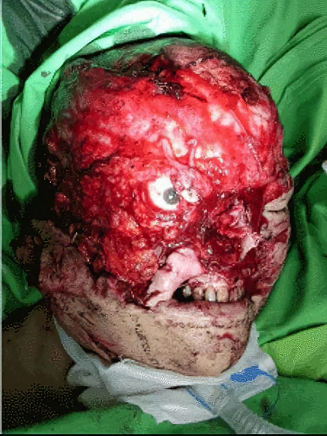 Severe facial trauma of varying degrees