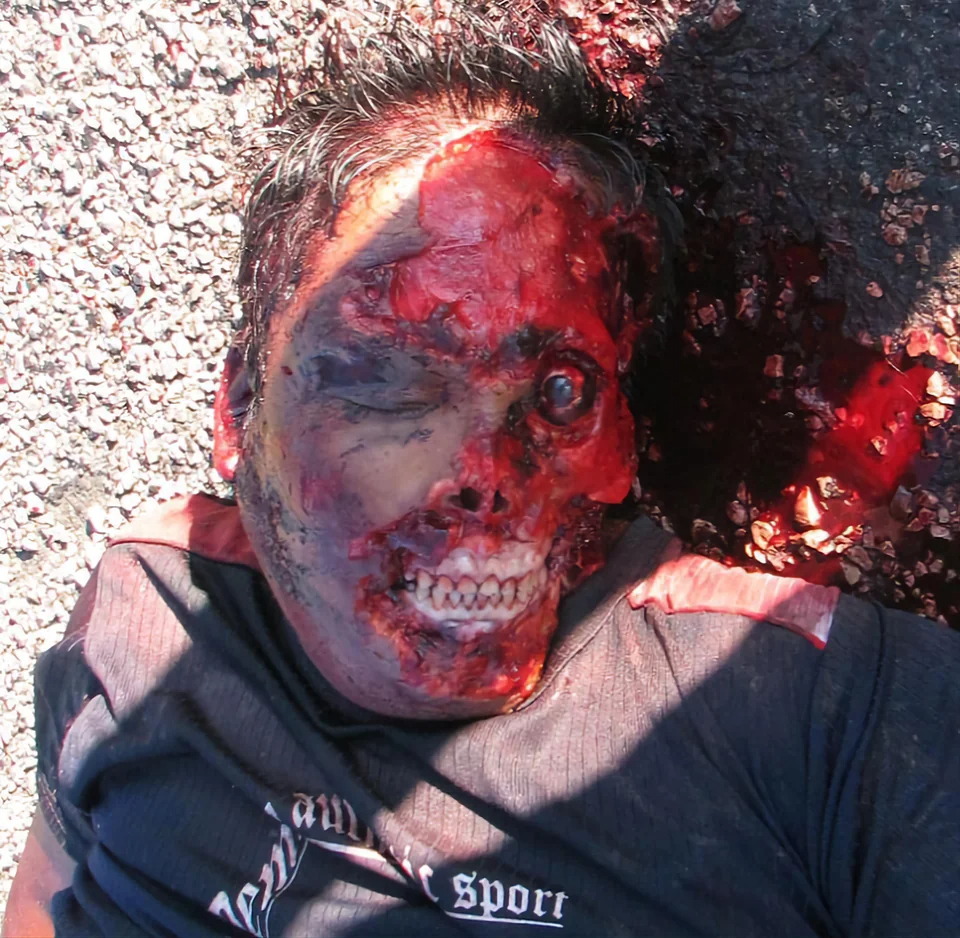 Severe facial trauma of varying degrees