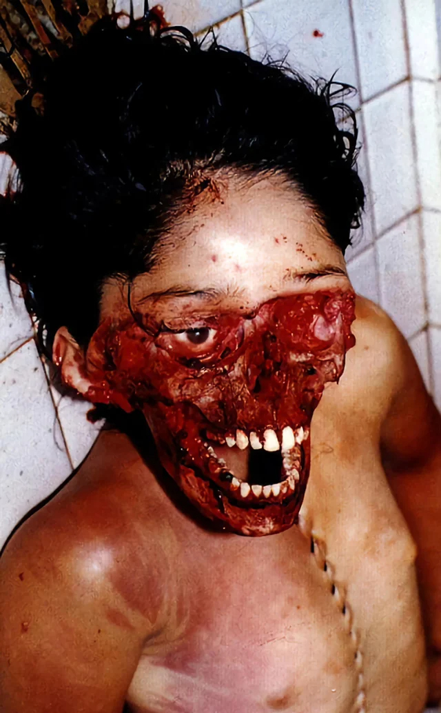 Severe facial trauma of varying degrees