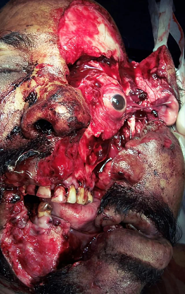 Severe facial trauma of varying degrees