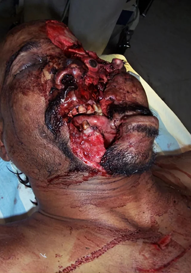 Severe facial trauma of varying degrees