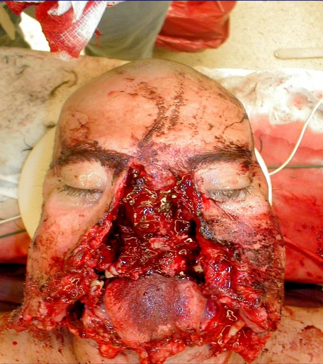 Severe facial trauma of varying degrees