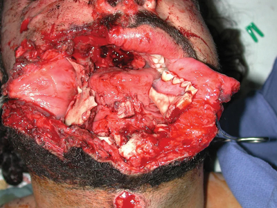 Severe facial trauma of varying degrees