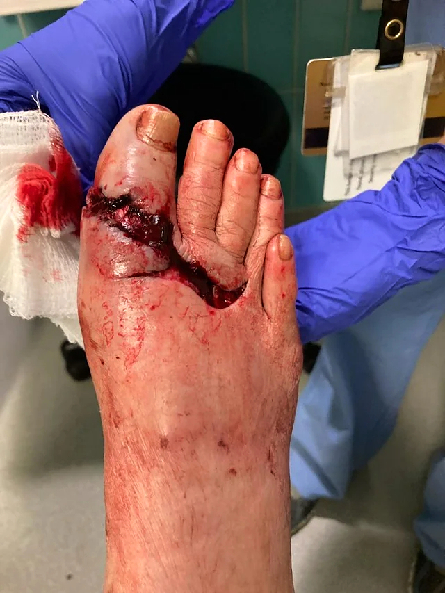 Trailer fell onto foot