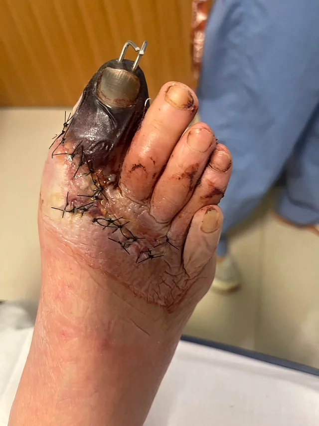 Trailer fell onto foot