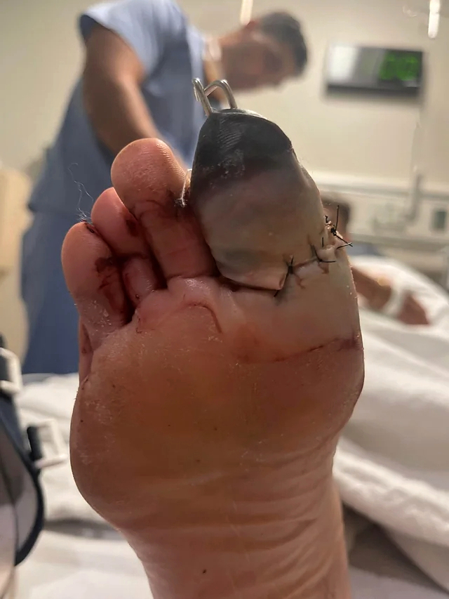 Trailer fell onto foot