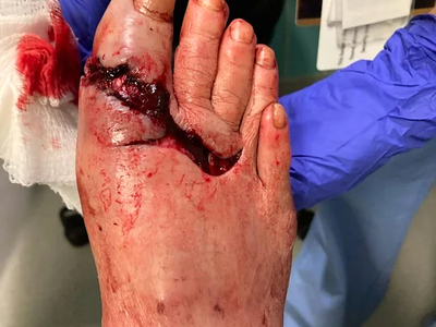 Trailer fell onto foot