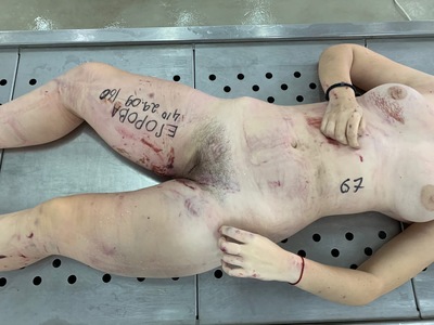 Young woman with cracked skull