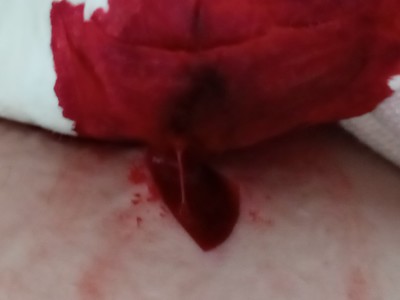 What not to do with a butterfly knife. 