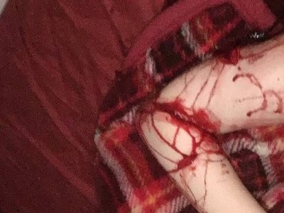 depressed teenager bloody self harm 