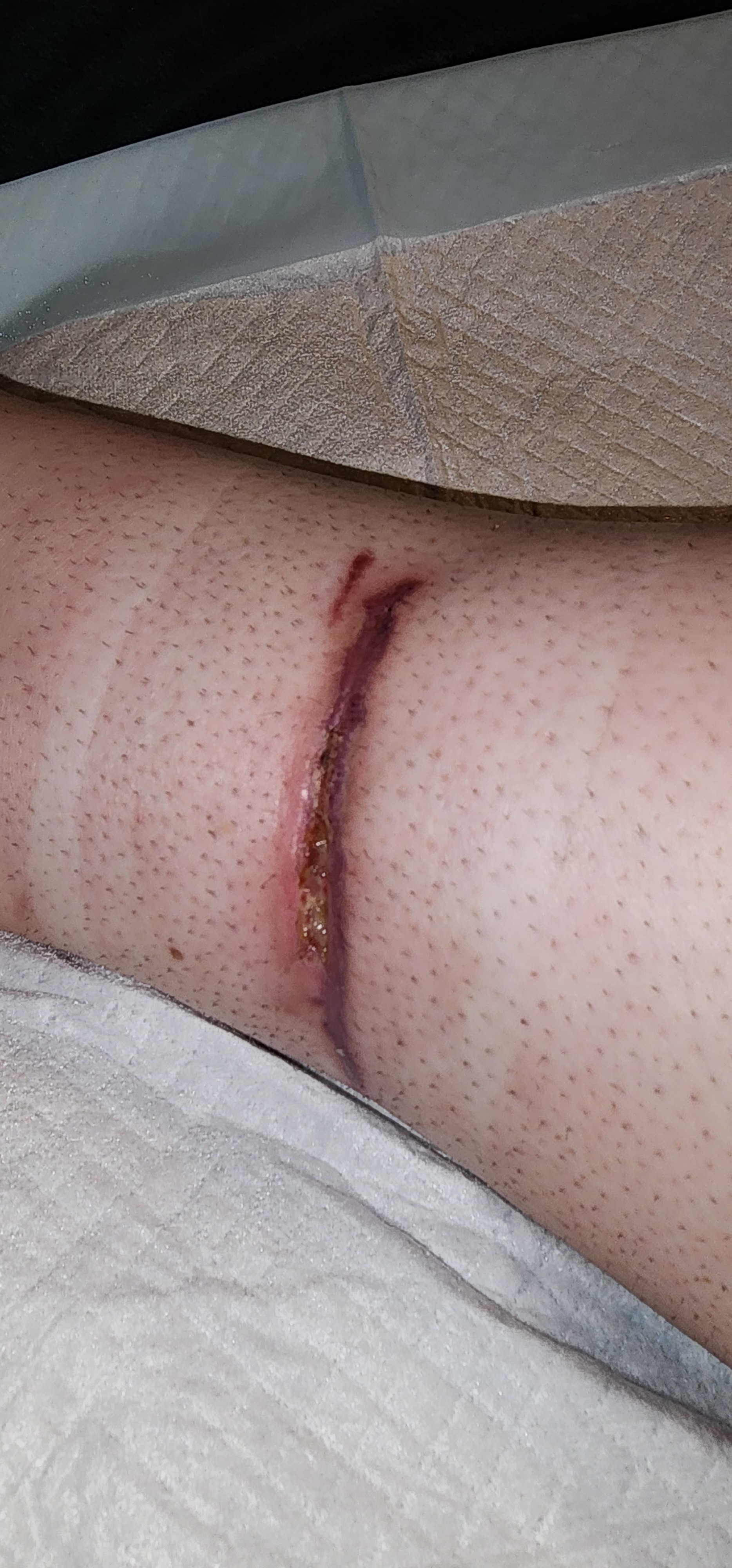 Dog bite wound