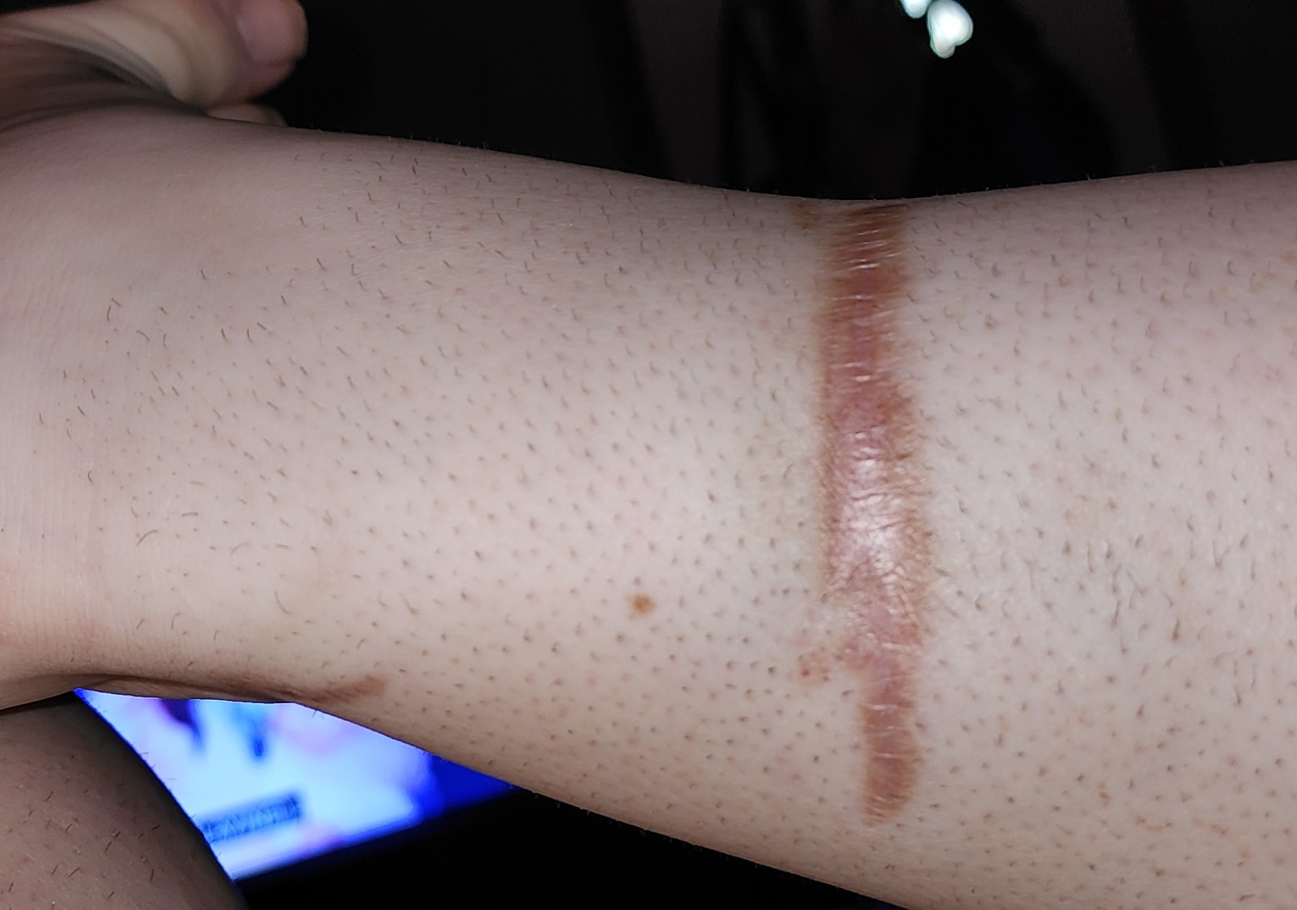 Dog bite wound