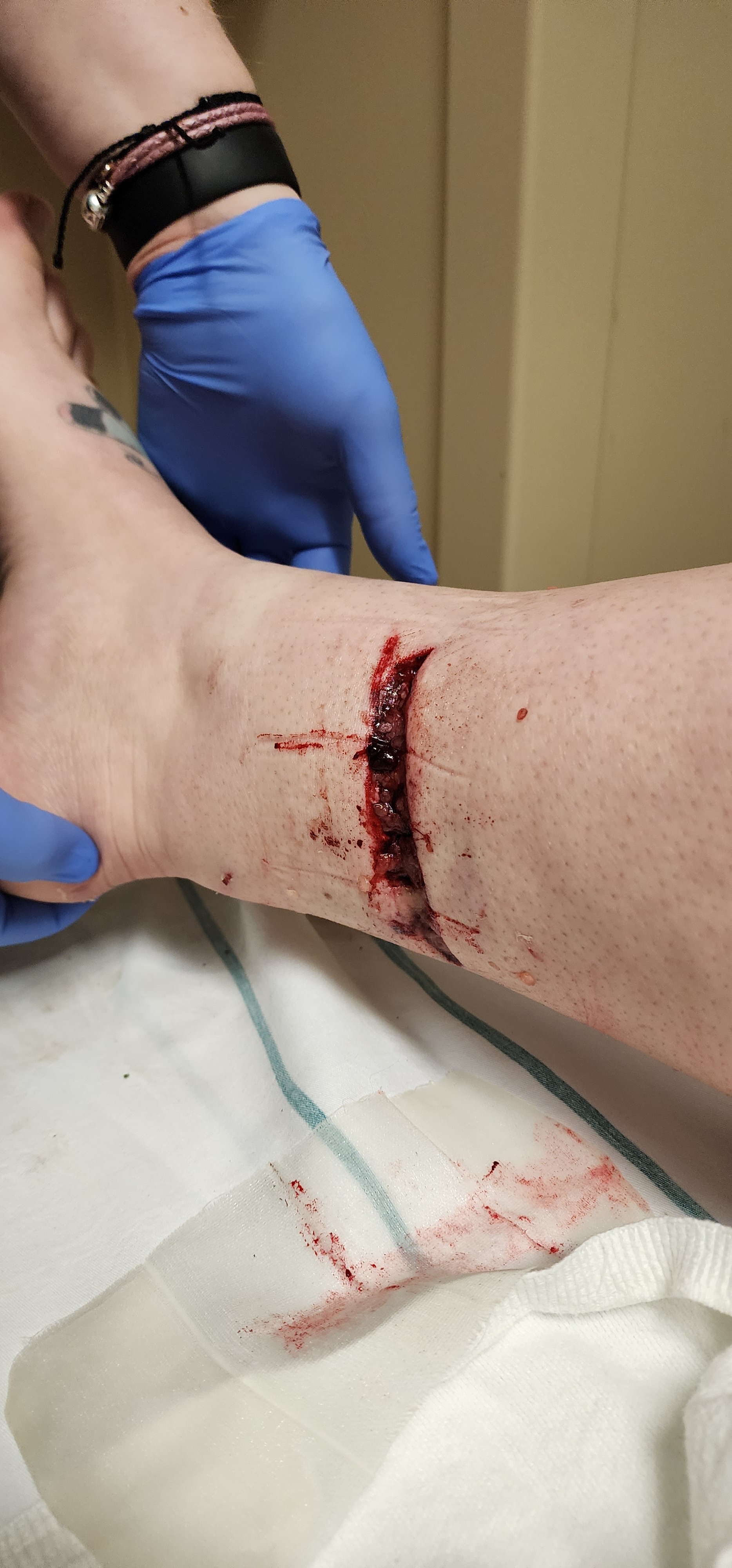 Dog bite wound
