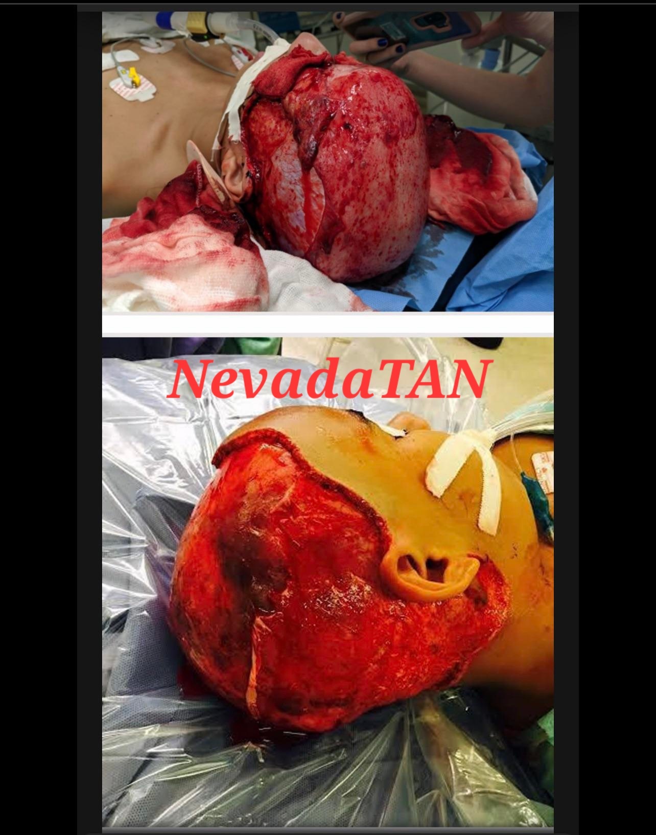 Kids scalp pulled off in a Go-Kart accident