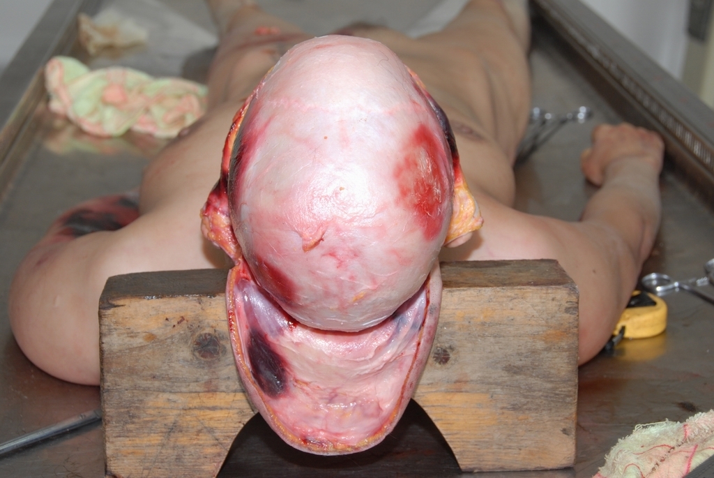 Bald Woman Autopsy