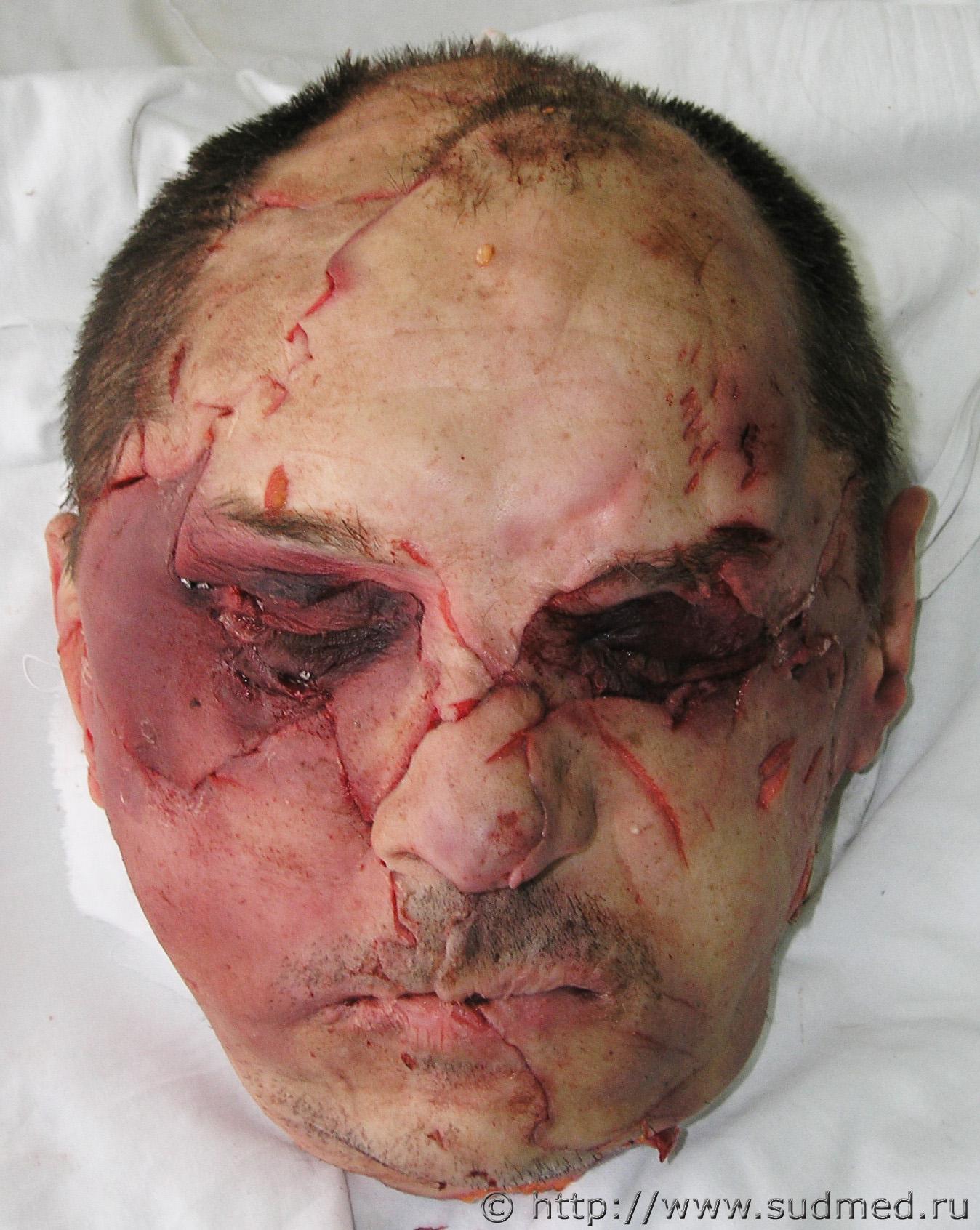 Russian Alcoholic Dismembers Another Alcoholics Head