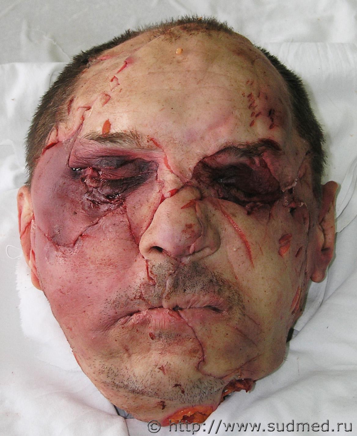 Russian Alcoholic Dismembers Another Alcoholics Head