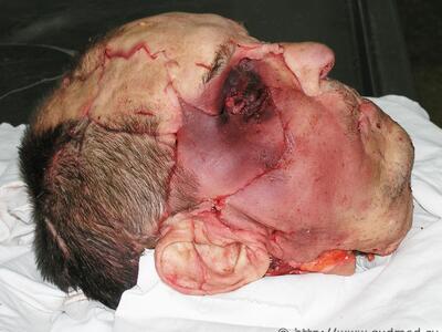 Drunk Man Killed His Drinking Buddy And Cut Off His Face And Scalp