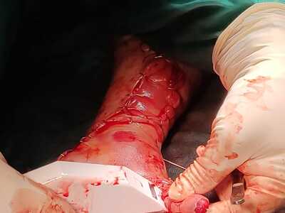 Arm reconstruction of the police officer in Lima bus accident.