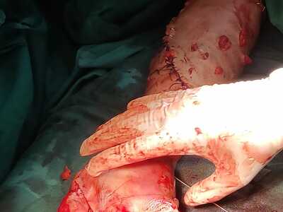 Arm reconstruction of the police officer in Lima bus accident.