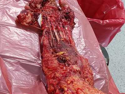 Arm reconstruction of the police officer in Lima bus accident.