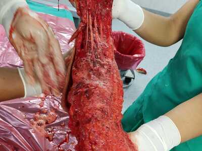 Arm reconstruction of the police officer in Lima bus accident.