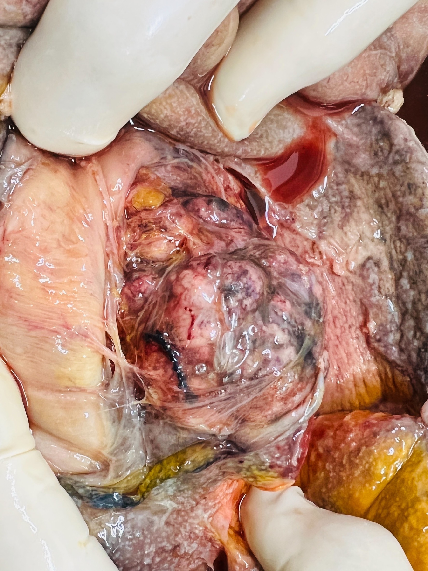 Autopsy, necrotic tissue