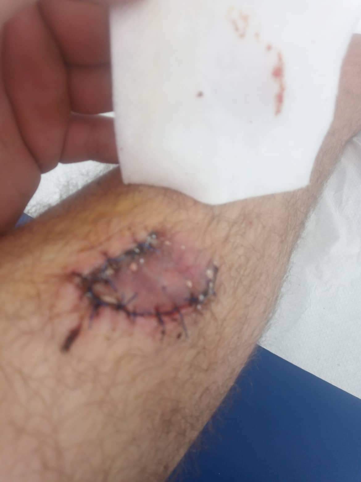 Bike crash injuries.