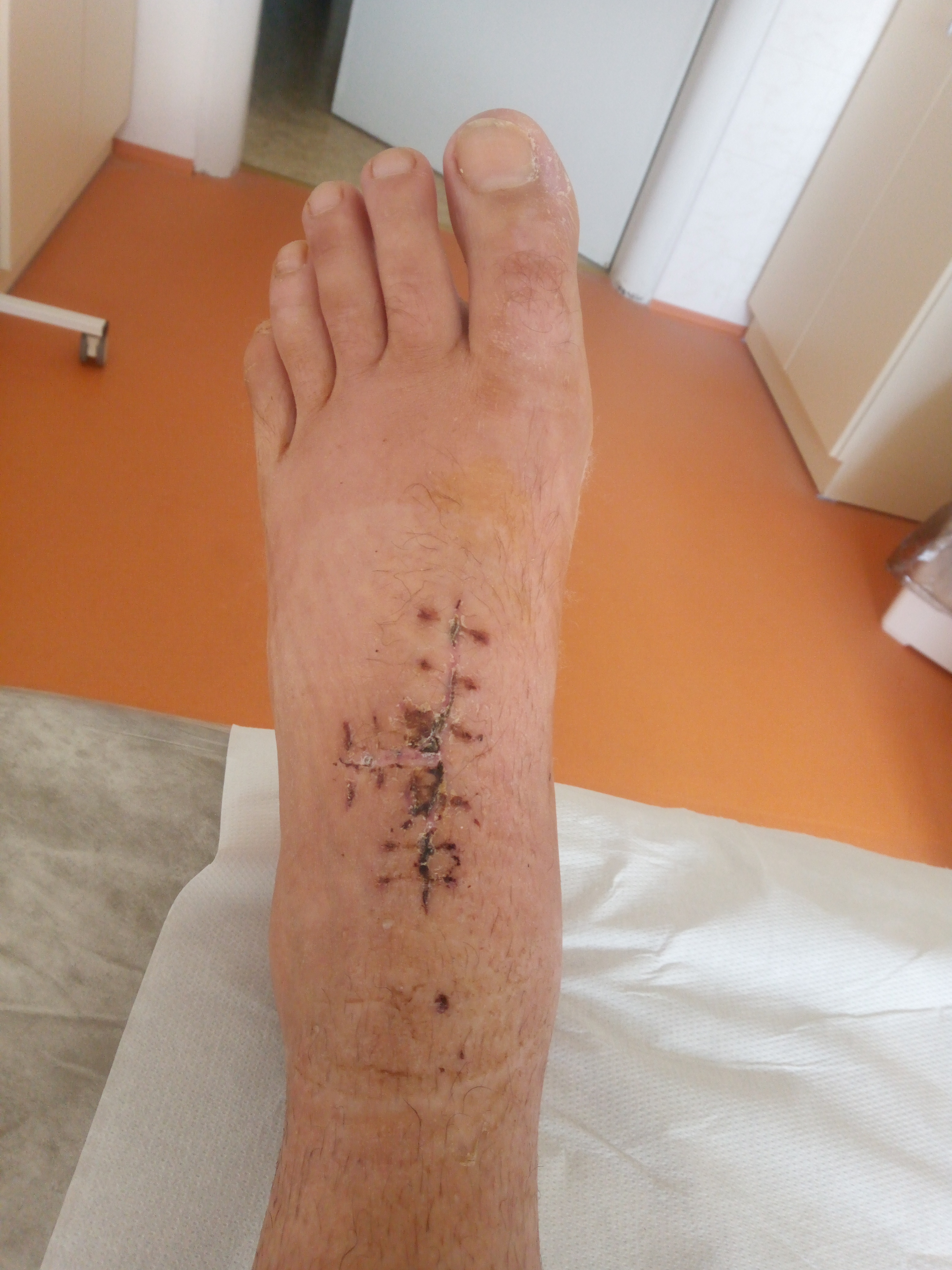 Bike crash injuries.