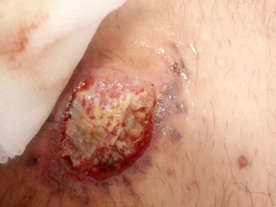 Bike crash injuries.