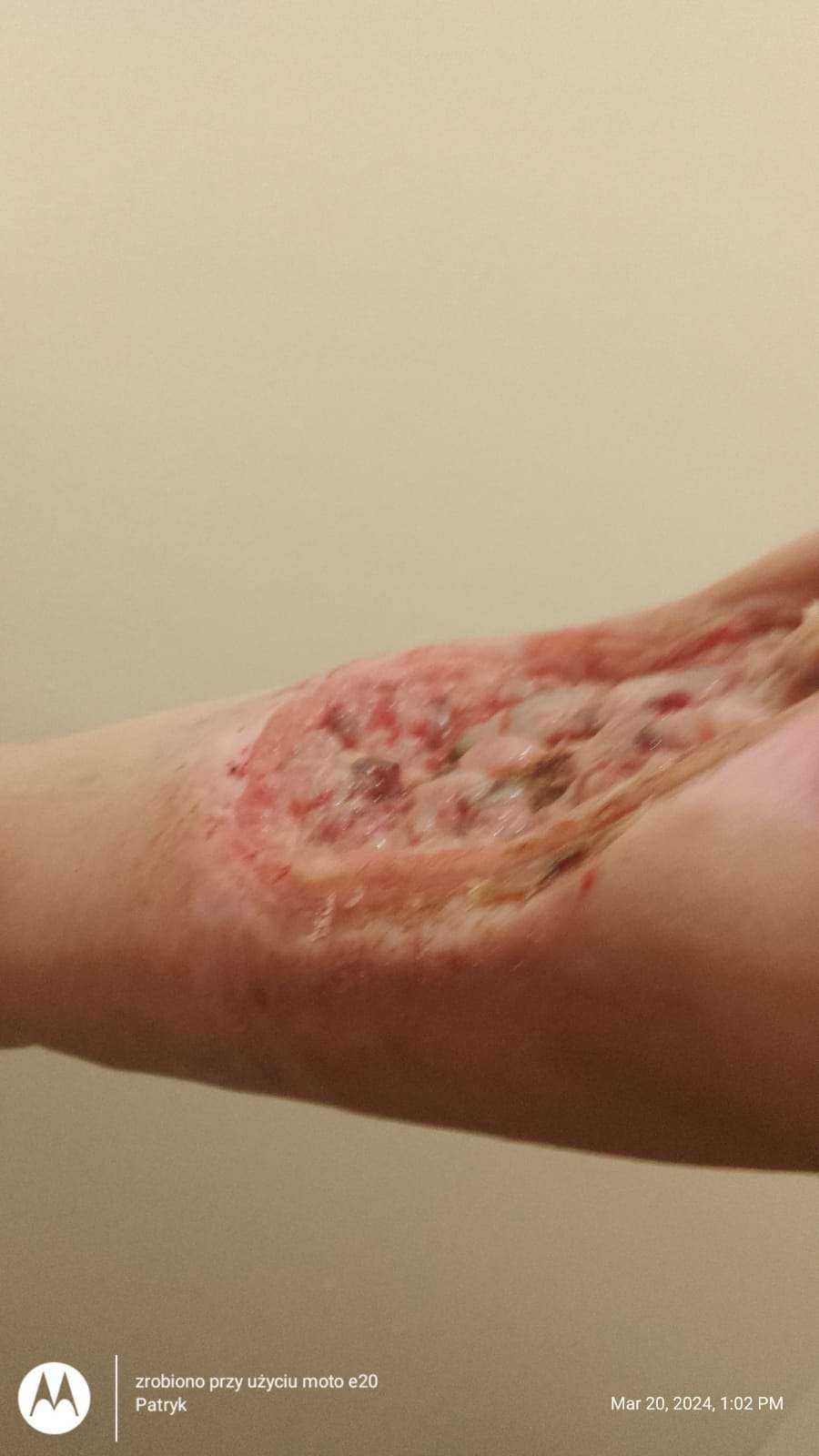 Necrosis in heroin user.