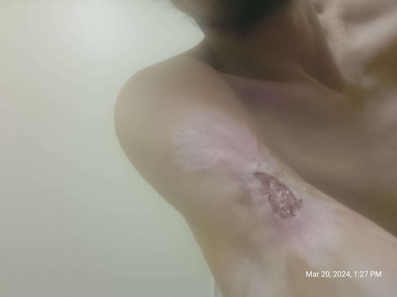 Necrosis in heroin user.