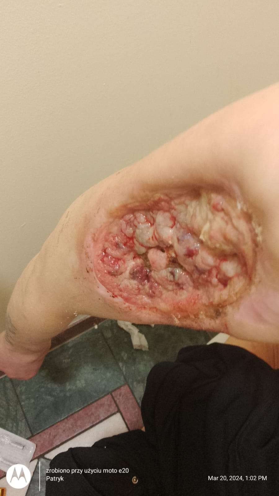 Necrosis in heroin user.