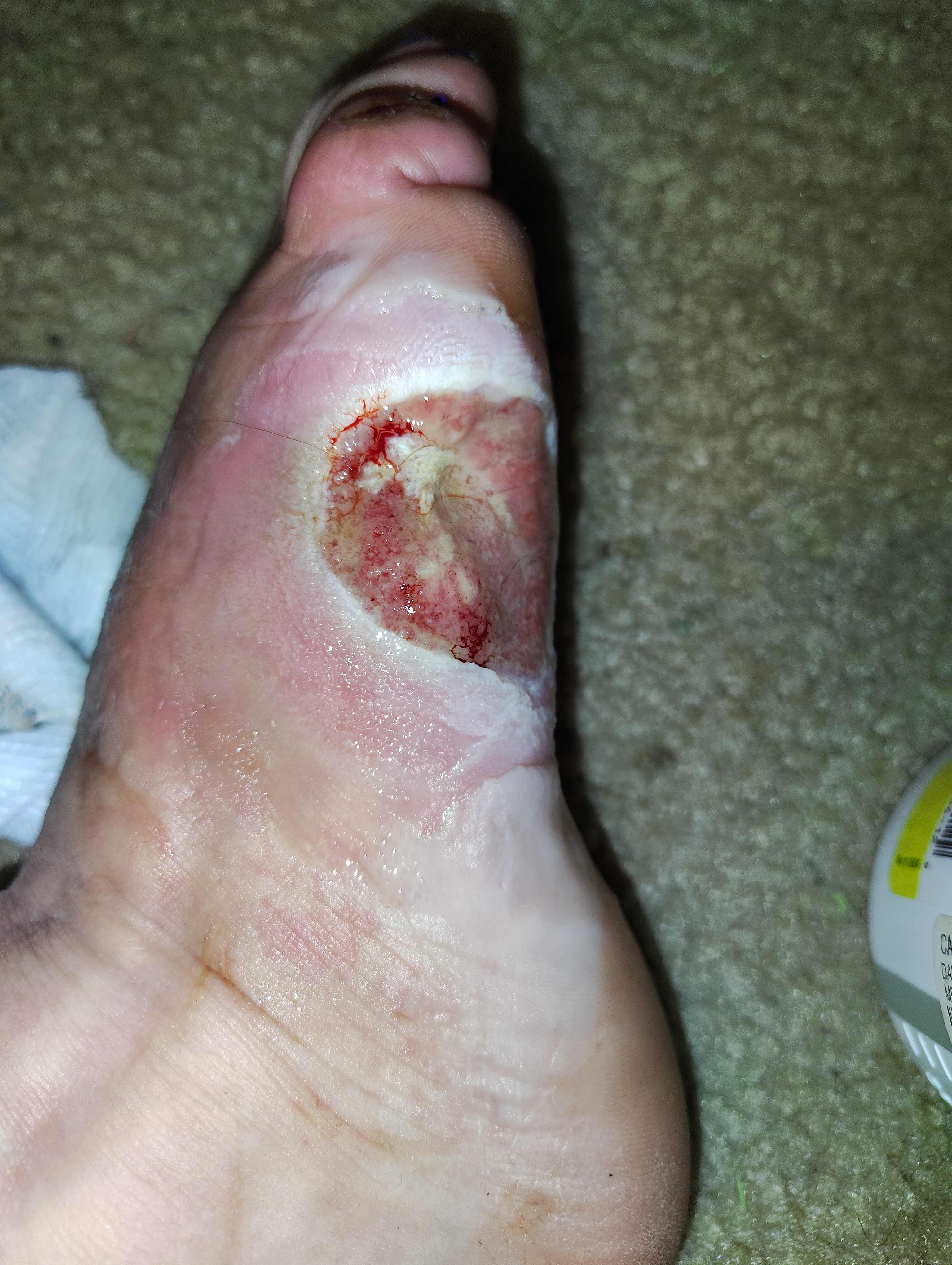Burned foot aftermath, after 2 surgeries