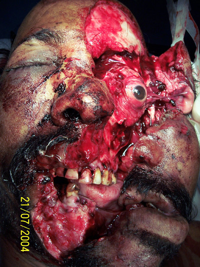 Extensive craniofacial trauma