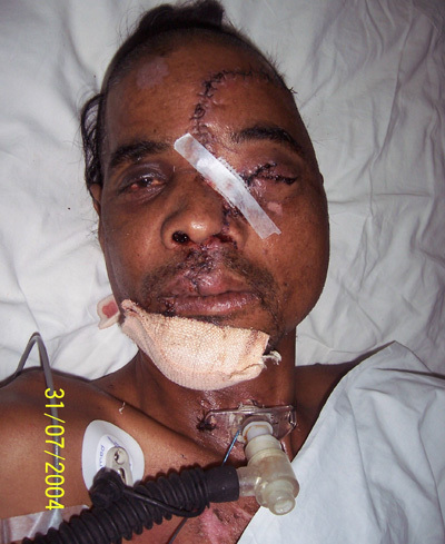 Extensive craniofacial trauma