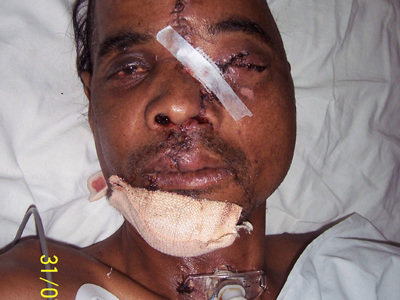 Extensive craniofacial trauma