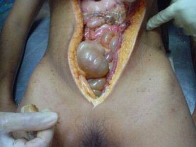 MURDER VICTIM AUTOPSY