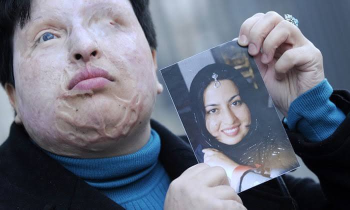 Student Pours Acid On Iranian Woman Because Of Rejected Love