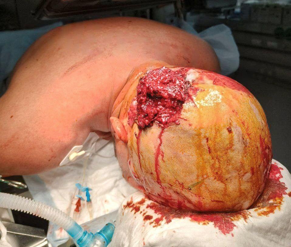 Survivors of the Ukrainian motorized special forces receive medical tr