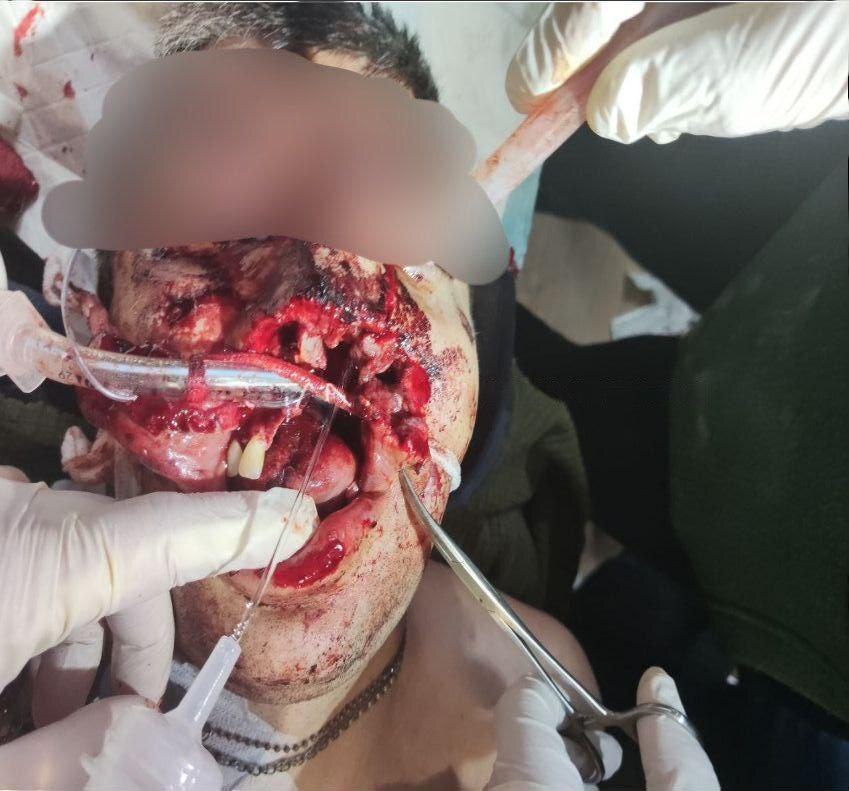 Survivors of the Ukrainian motorized special forces receive medical tr