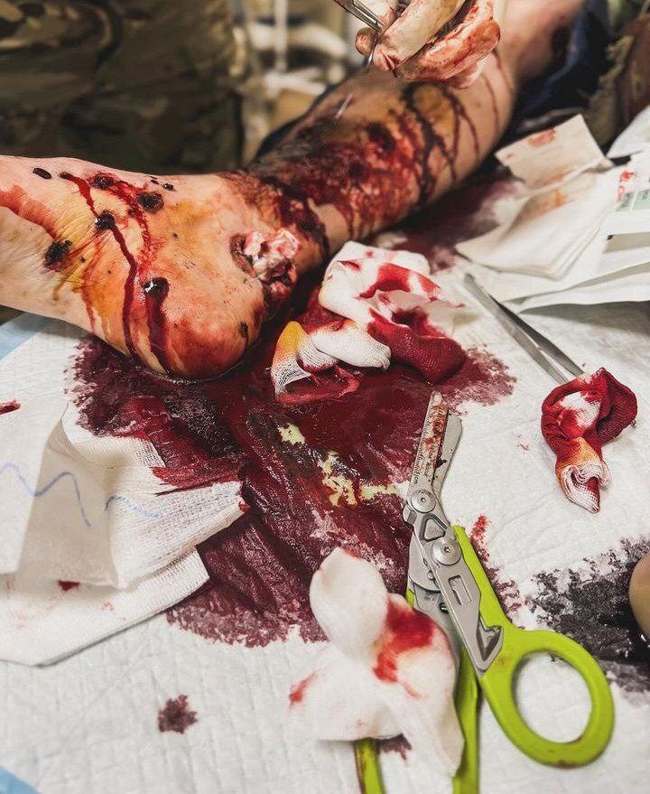 Survivors of the Ukrainian motorized special forces receive medical tr