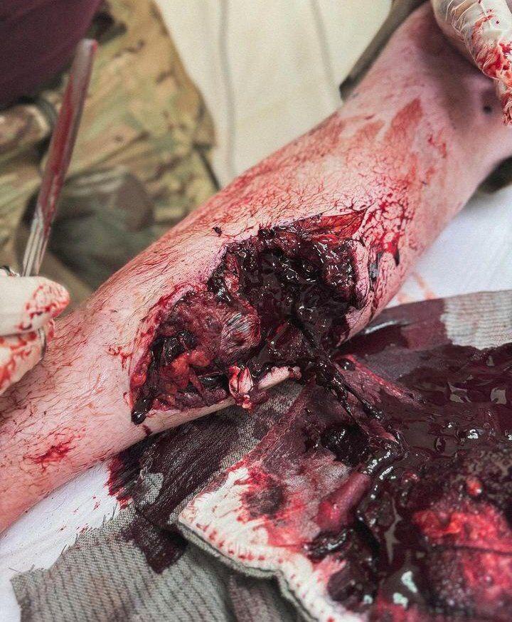 Survivors of the Ukrainian motorized special forces receive medical tr