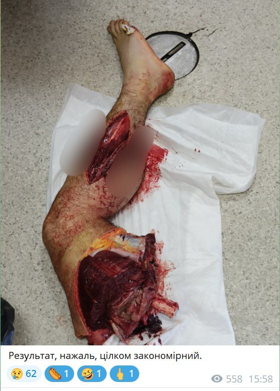 Survivors of the Ukrainian motorized special forces receive medical tr