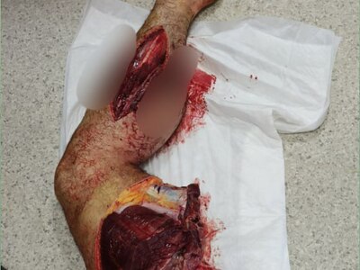 Survivors of the Ukrainian motorized special forces receive medical tr