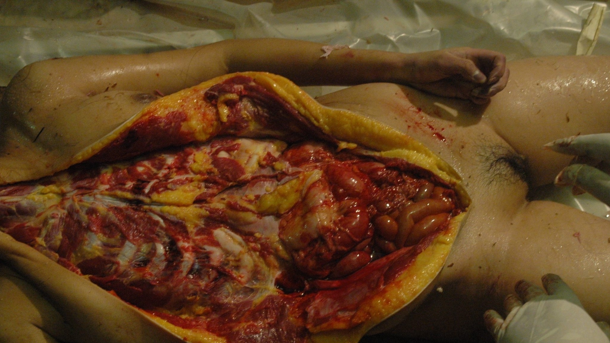 Brutally murdered Chinese woman - Autopsy